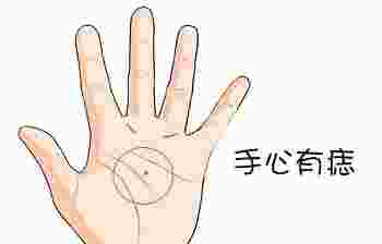 手掌有痣图解大全_手掌有痣代表什么意思