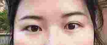 一双一单眼皮的人是阴阳眼吗_一双一单眼皮的人还能变成双吗