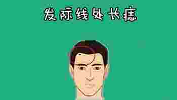 藏在发际线的痣男人_藏在发际线的痣容易恶变吗