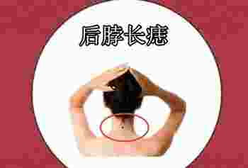 脖子后面有个痣好不好_脖子后边有痣代表什么意思