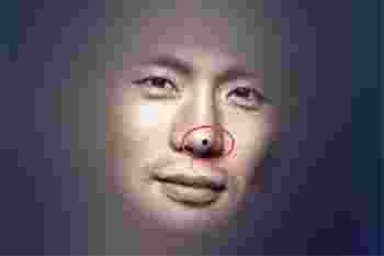 去掉刀厄痣能破灾吗_刀厄痣可不可以去点掉