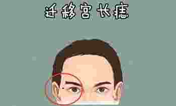 迁移宫有痣的男人_迁移宫有痣的富豪